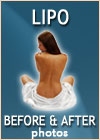 body shaping smartlipo liposuction-before-after-photos-oxnard-ventura-dr-hanna