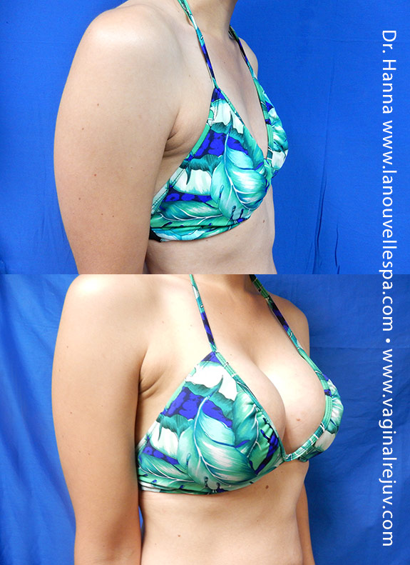 Breast Augmentation by Dr. Hanna, Silicone Implants