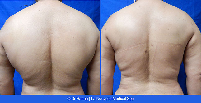 vaser liposuction smartlipo before after photos, Dr. Hanna La Nouvelle Medical Spa, Oxnard, Ventura county female shoulders 